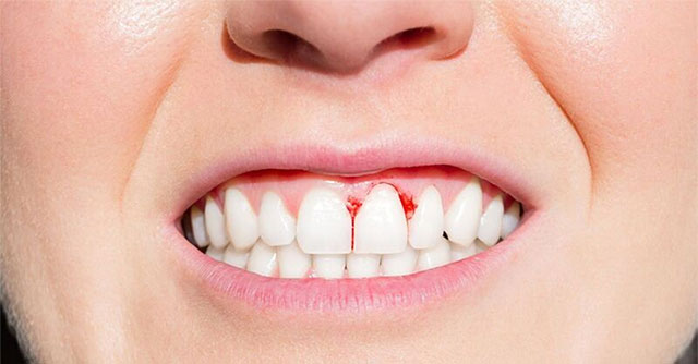 Nguyên nhân gây bệnh viêm răng lợi