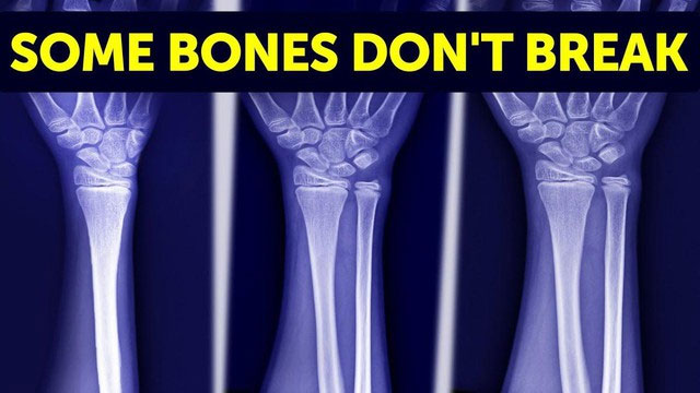 Đột biến gene này khiến xương cứng hơn nhiều lần so với người bình thường.