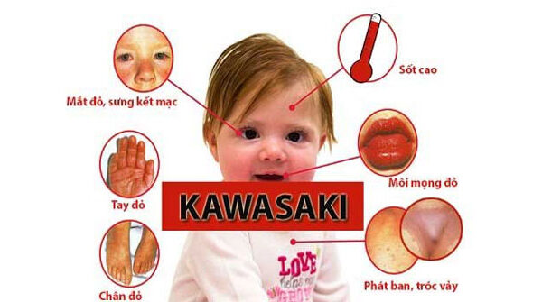 Bệnh Kawasaki: Nguyên nhân, triệu chứng và cách điều trị