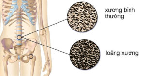 Top 4 loại thực phẩm là “Vua ăn cắp canxi”, khiến nhiều người ngã nhẹ đã gãy xương