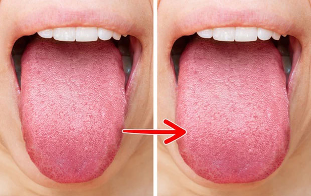 Lưỡi của bạn có thể bị béo lên
