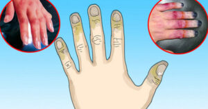 Cách chữa trị cho người bị bỏng lạnh