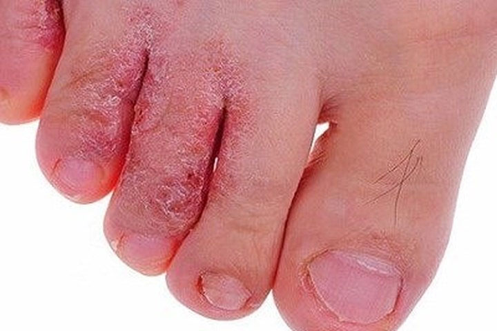 Mẹo trị nước ăn chân cực nhanh và an toàn